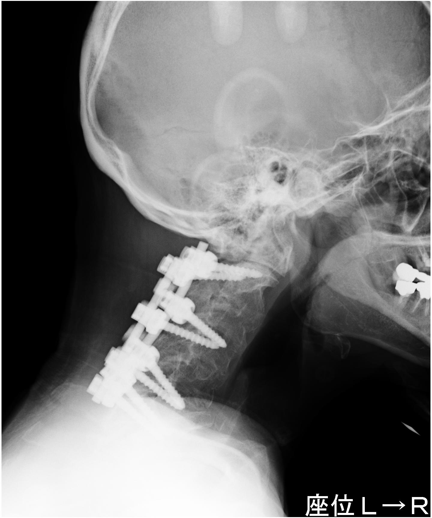 二次障害の手術３年目のレントゲン ｃｔ りーぶる ライフ Second